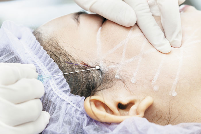 Cirurgia de lifting facial: PLA faz sucesso no fio da sutura.