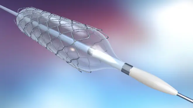 Cateter-balão: novo tipo de tubete plástico simplifica cirurgias invasivas.